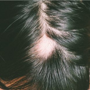Exemple de perte de cheveux